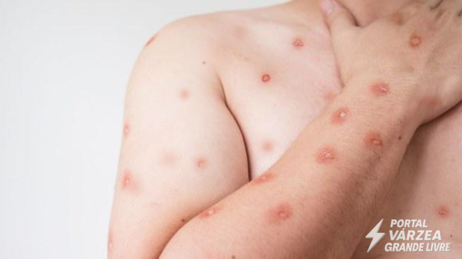 SES emite alerta para monitoramento de Mpox em MT após avanço de variante em Rondônia